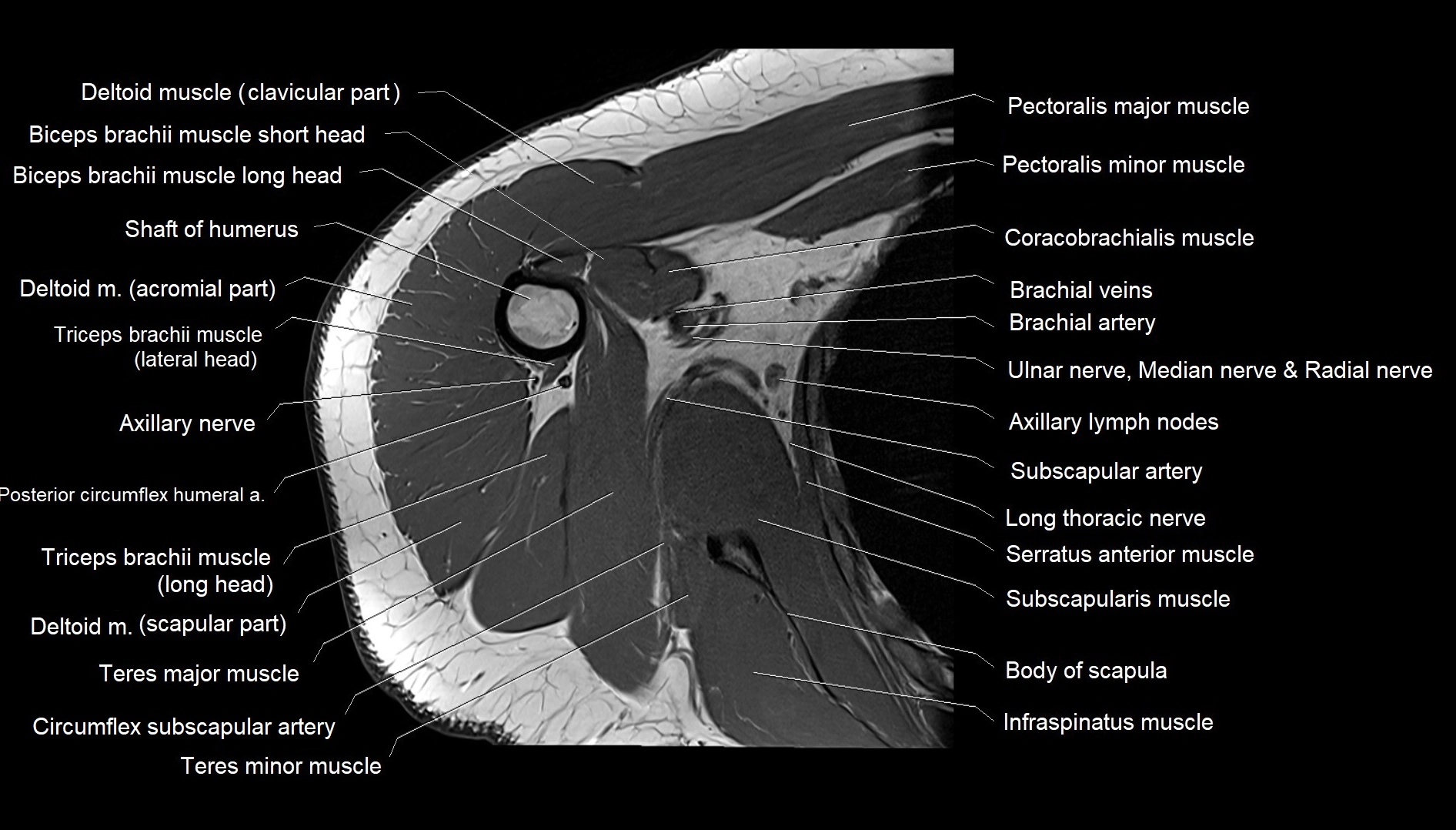 Shoulder cross sectional anatomy MRI 3T axial image 35.webp